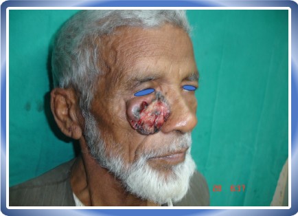 BASAL CELL CARCINOMA
